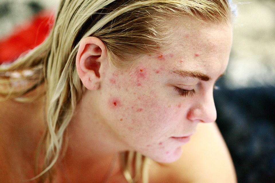 Les cicatrices d'acné